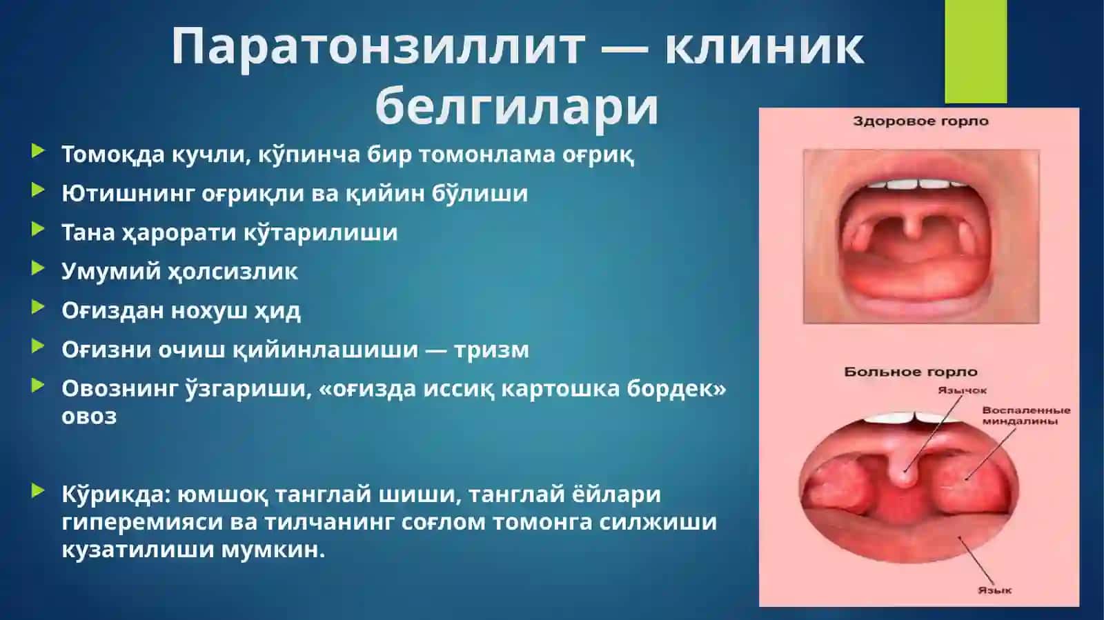 Паратонзиллит ВА 8-ТИШ ПЕРИКОРОНАРИТИ 3