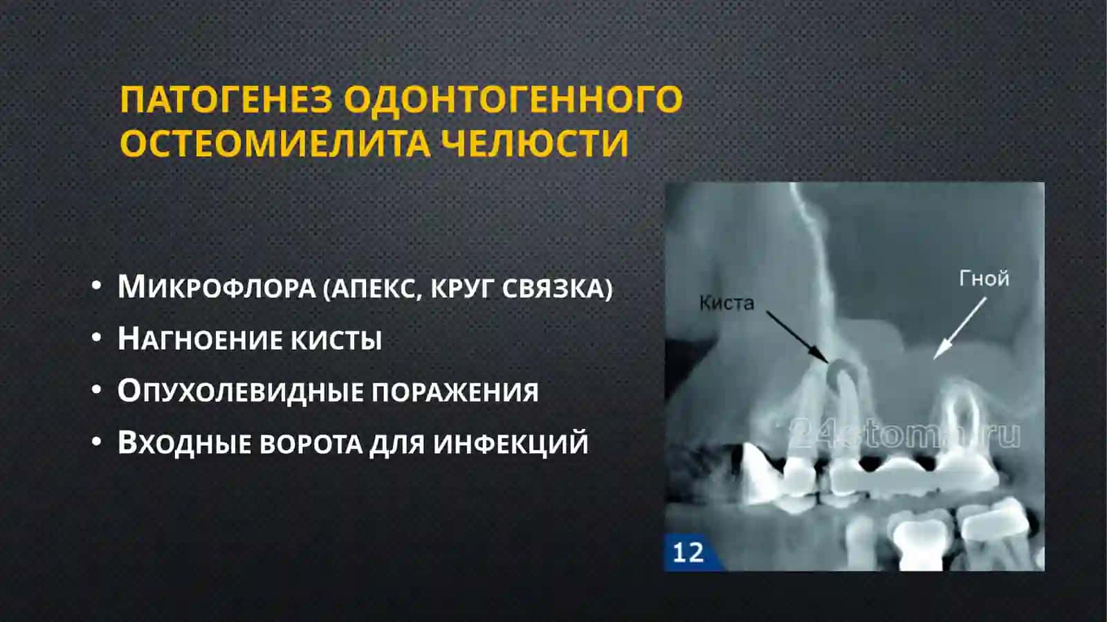 Одонтогенныйостеомиелитчелюсти 3