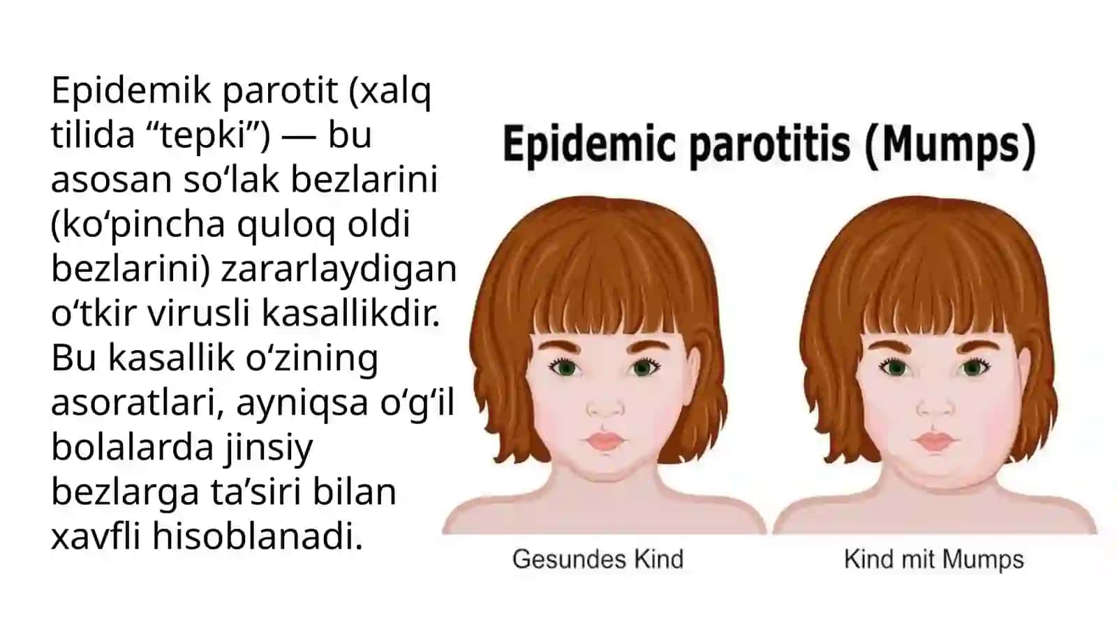 Epidemik parotit 3