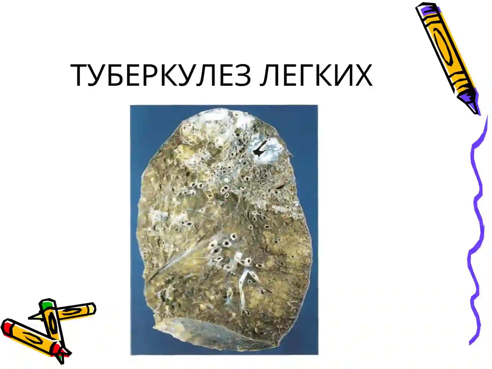 ТУБЕРКУЛЕЗ 3