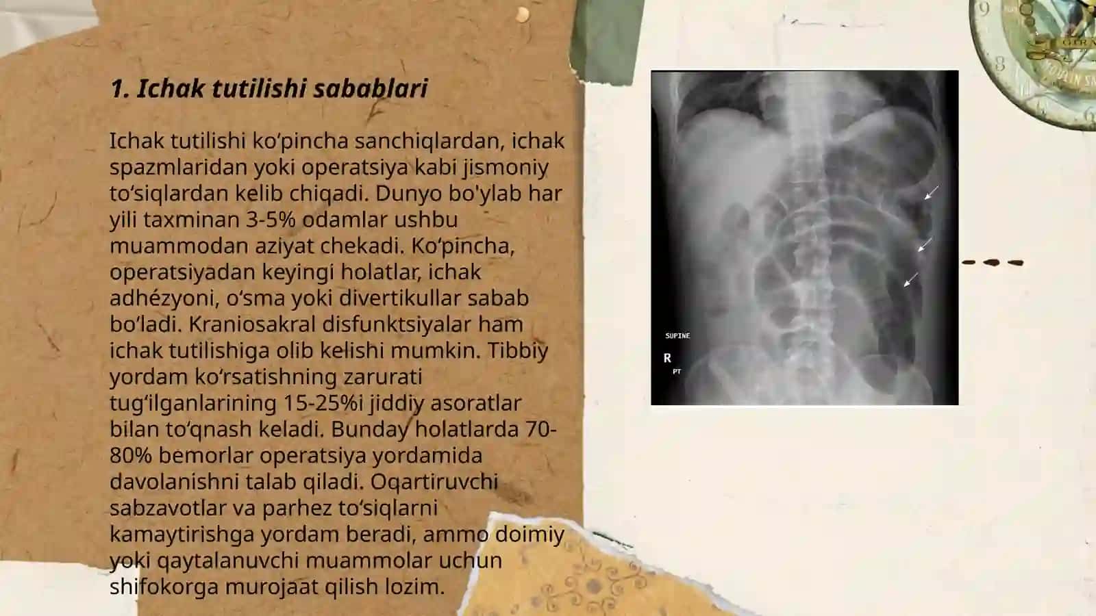 Ichak tutilishi 3