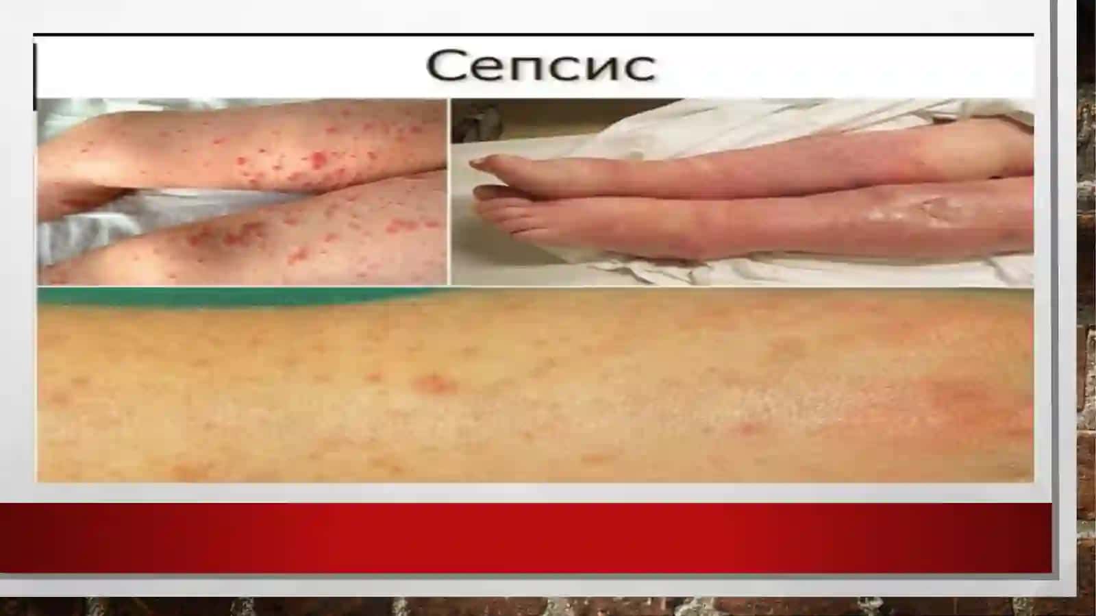sepsis kasalligi 3