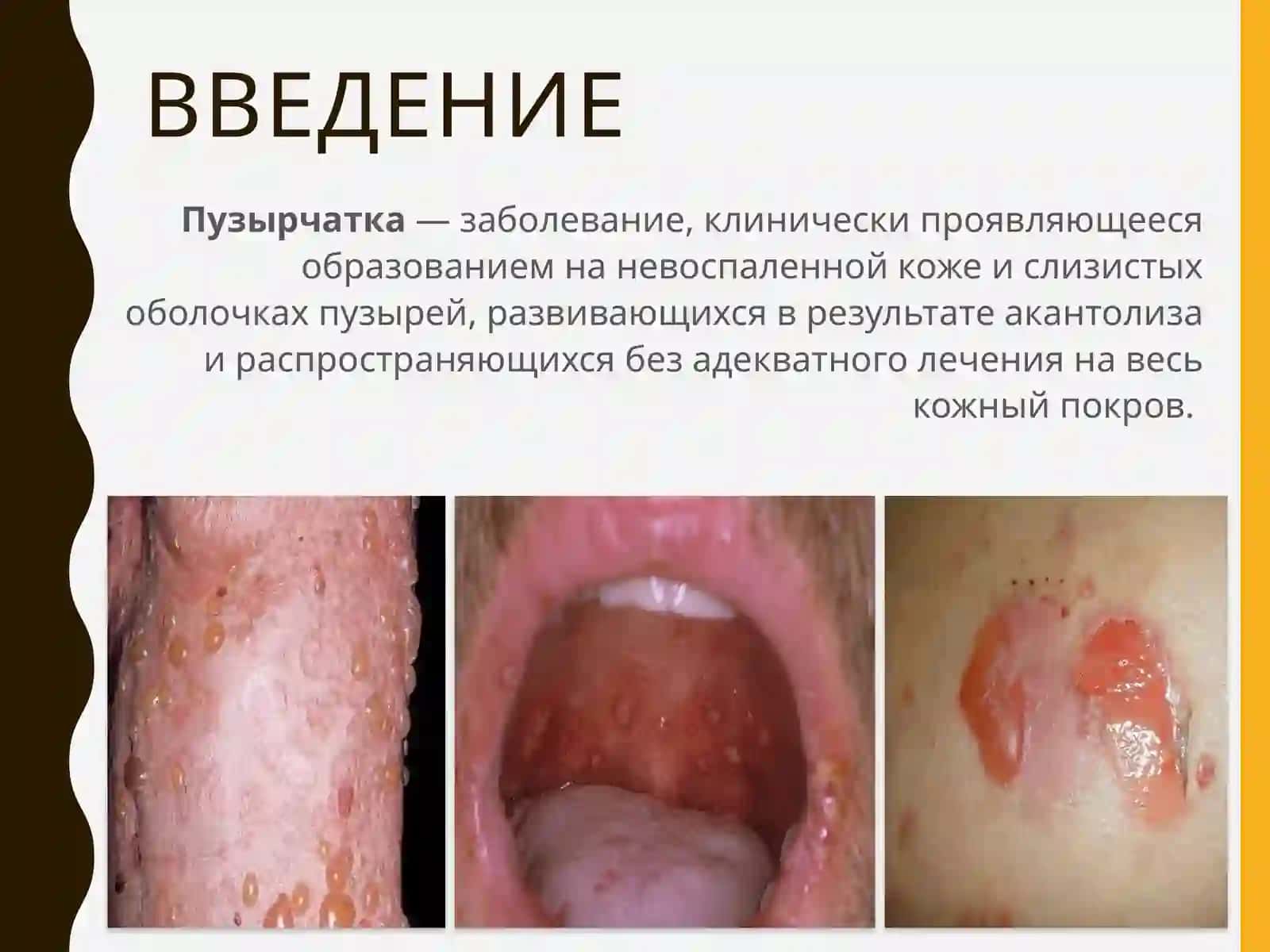 ПУЗЫРЧАТКА 3