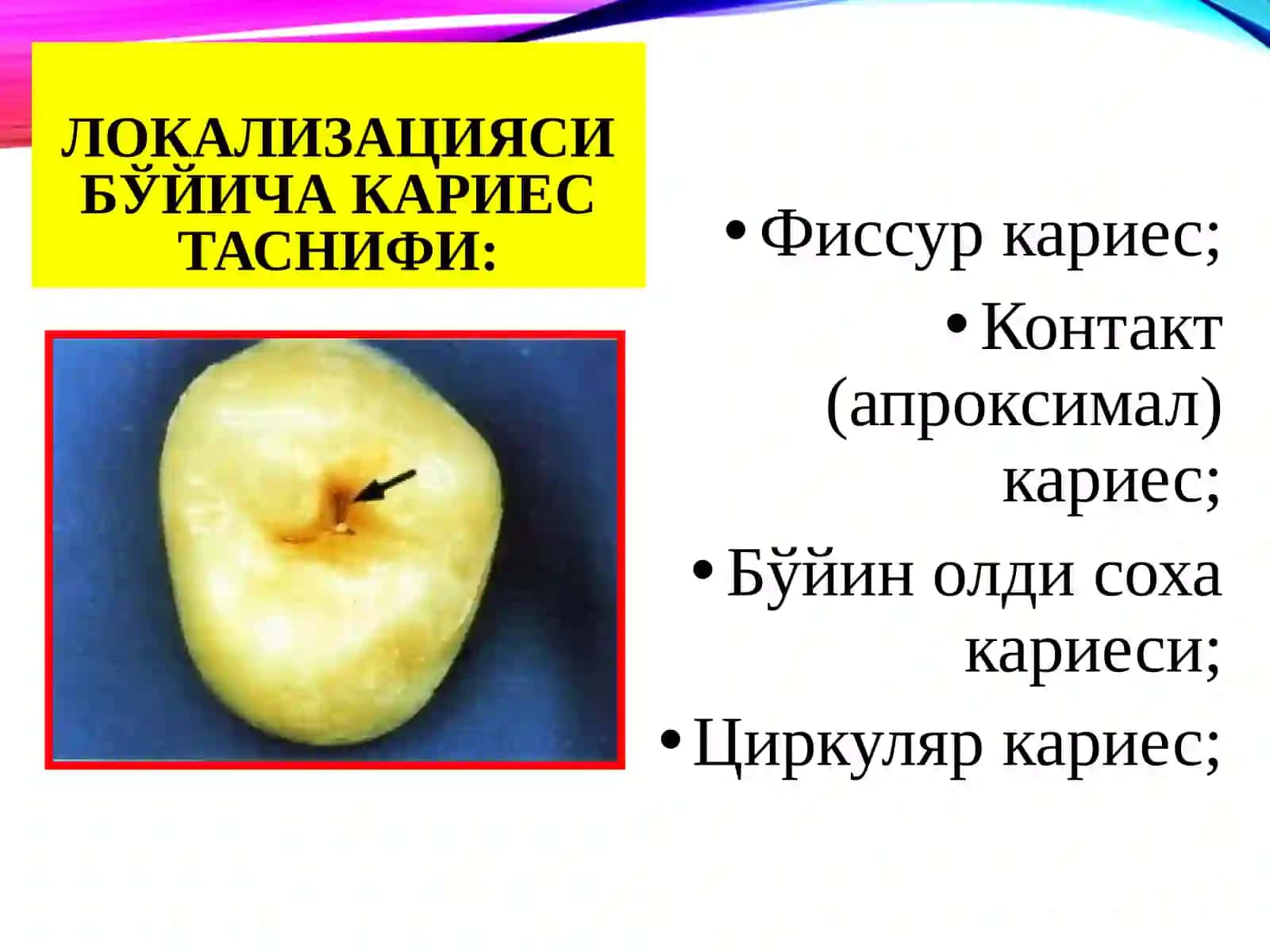 Тиш кариеси: қийосий ташхиси 3