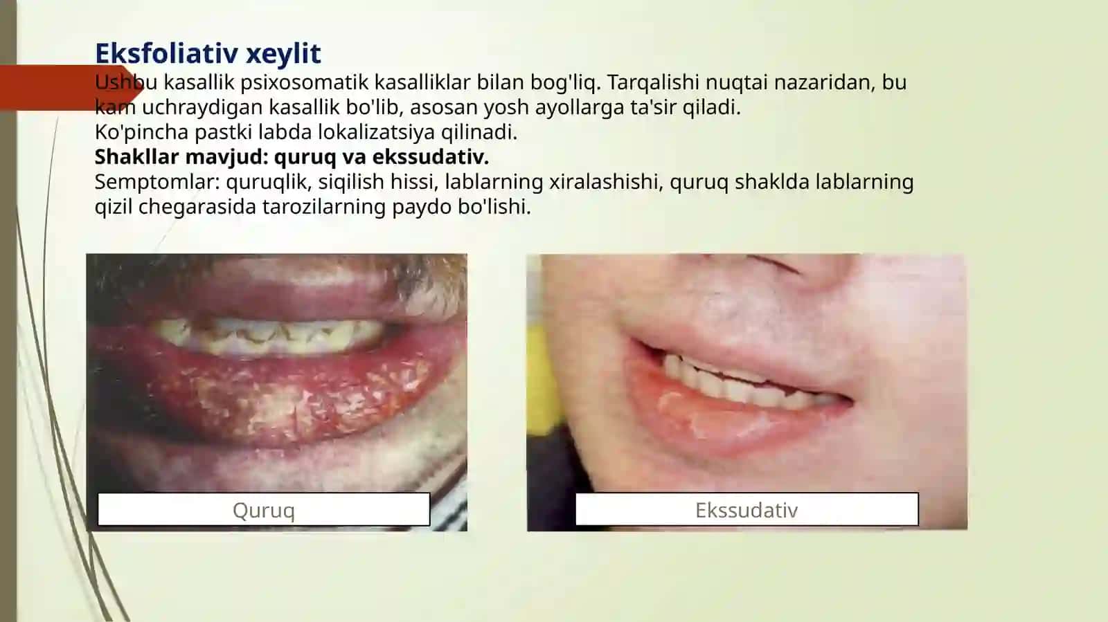 Xeylit kasalligi 3