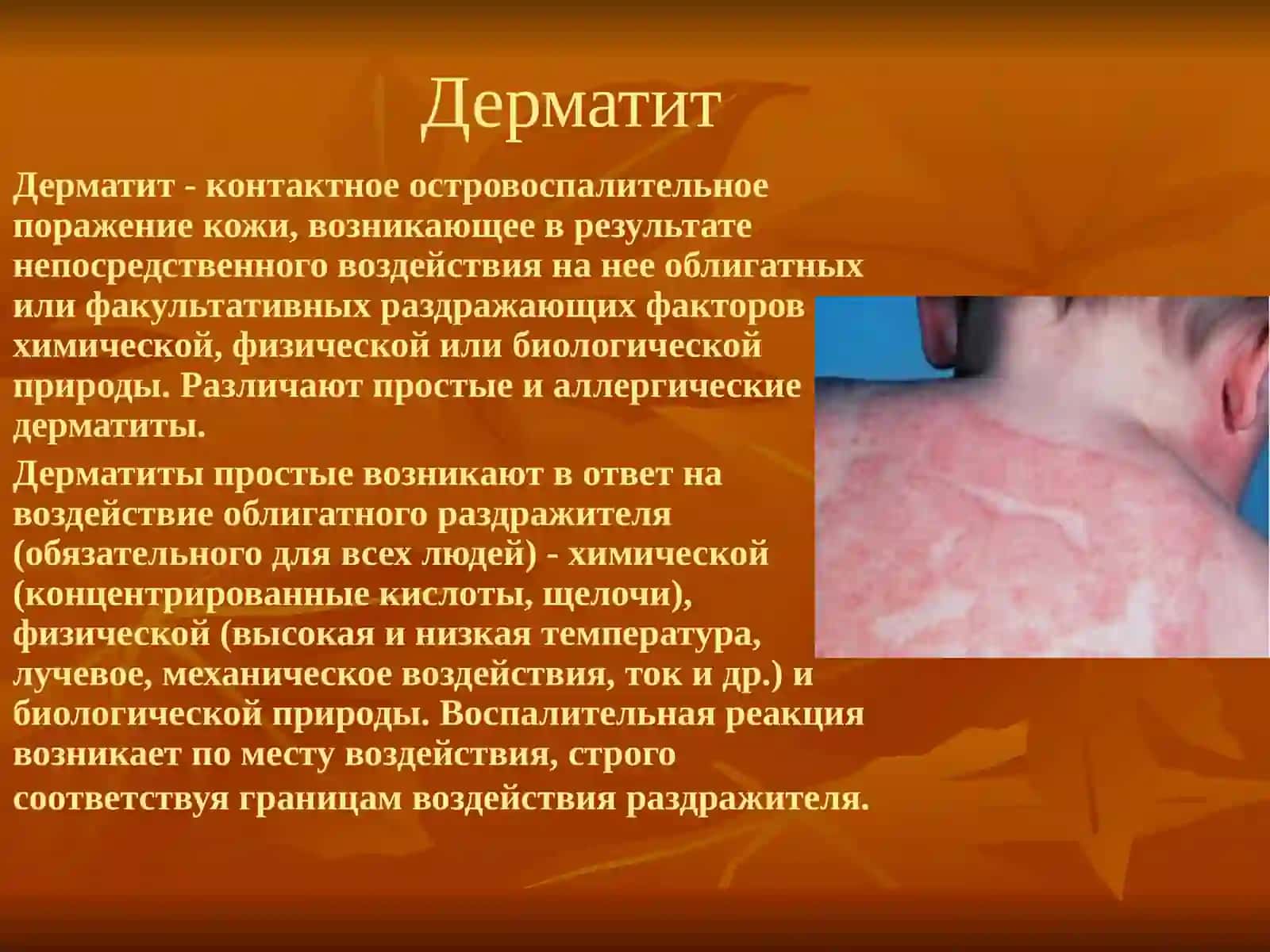 Аллергодерматозы 3