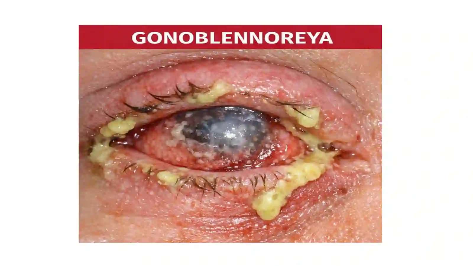 Gonokokkli kon’yunktivit(gonoblennoreya) 3