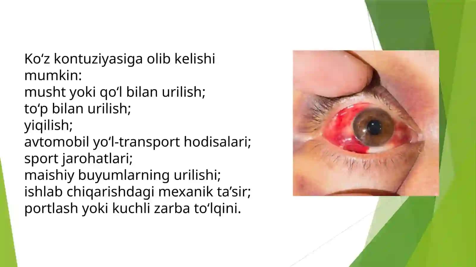 Ko’zkontuziyalari 3