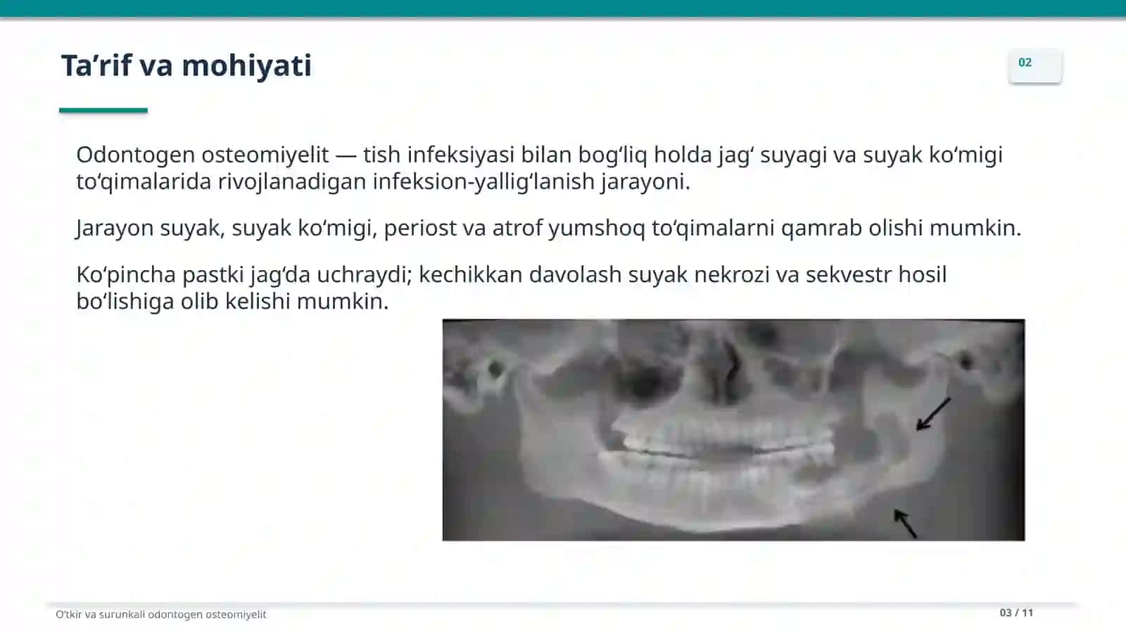 Oʻtkir va surunkali odontogen osteomiyelit 3