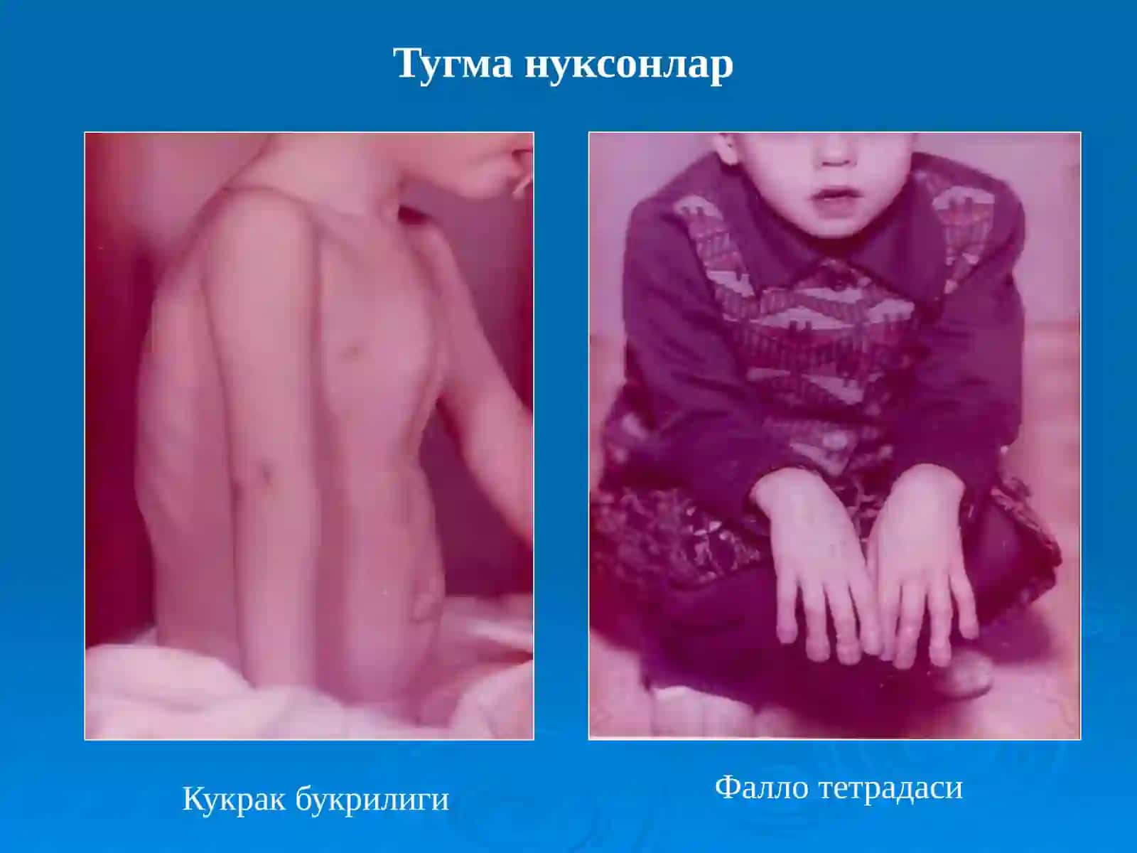 Туғма юрак нуқсонлари 3