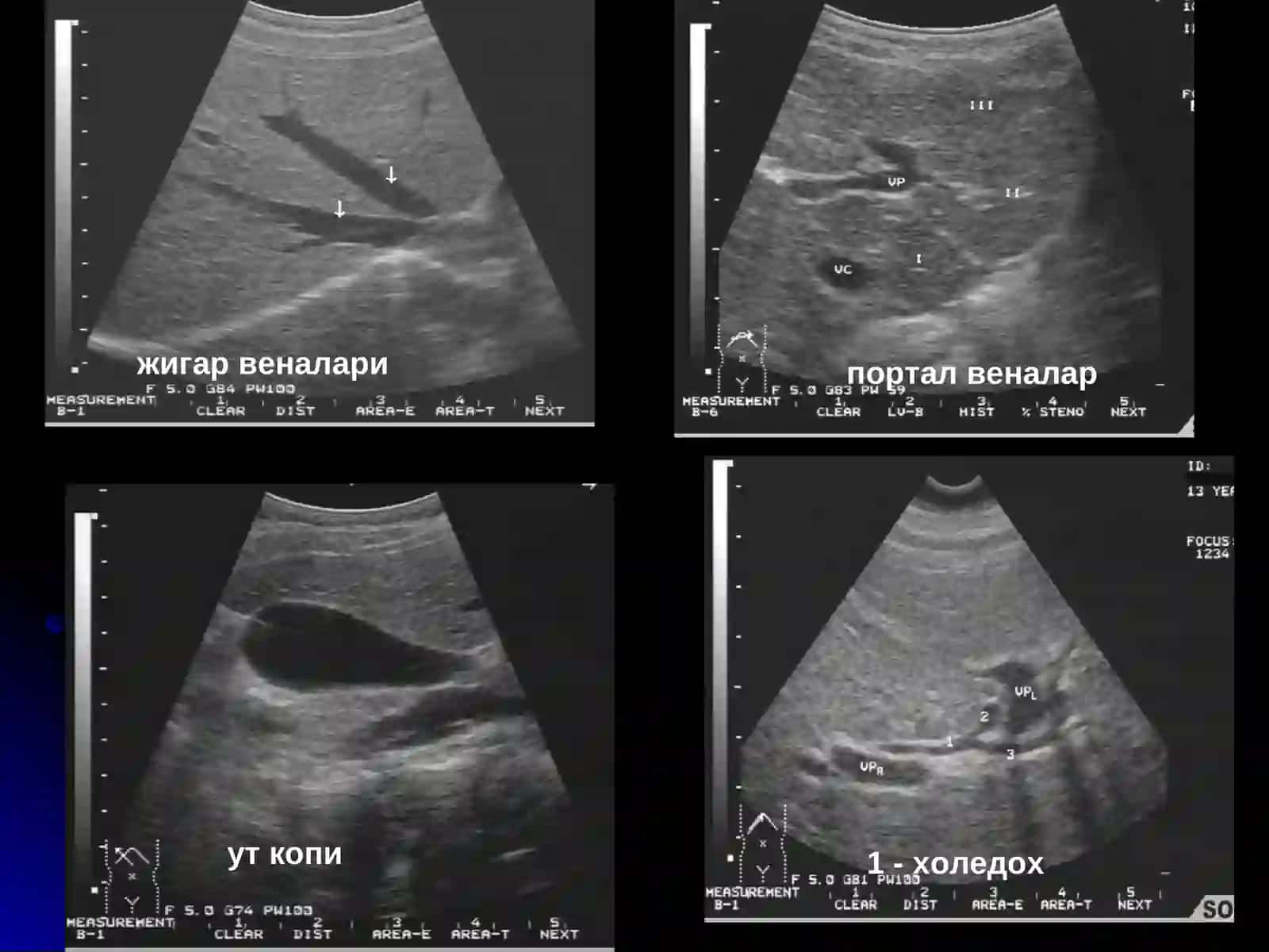 Жигар касалликалри нур ташхиси 3