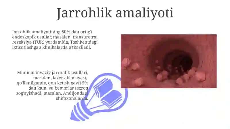 Urologiya adenoma 3