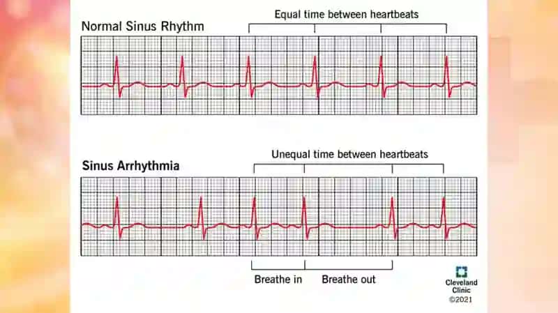 Sinus aritmi 3