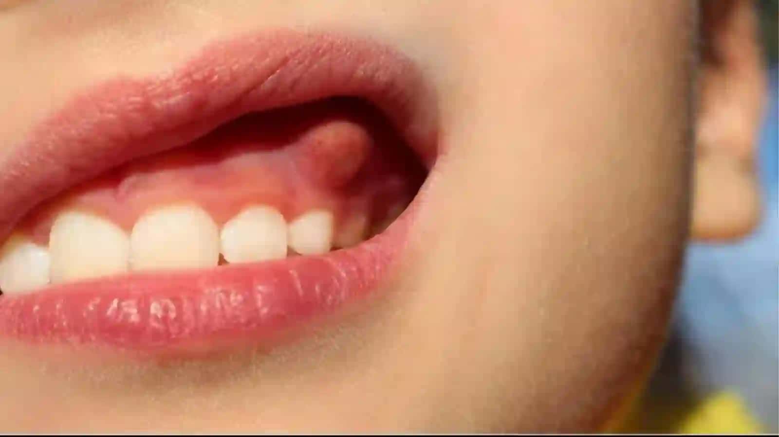 ZOʻRAYISHBOSQICHIDAGI SURUNKALIPERIODONTIT 3