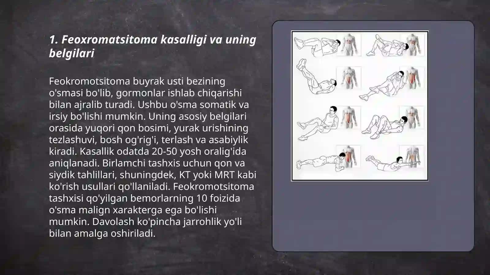 Feoxromatsitoma va davolash usullari 3