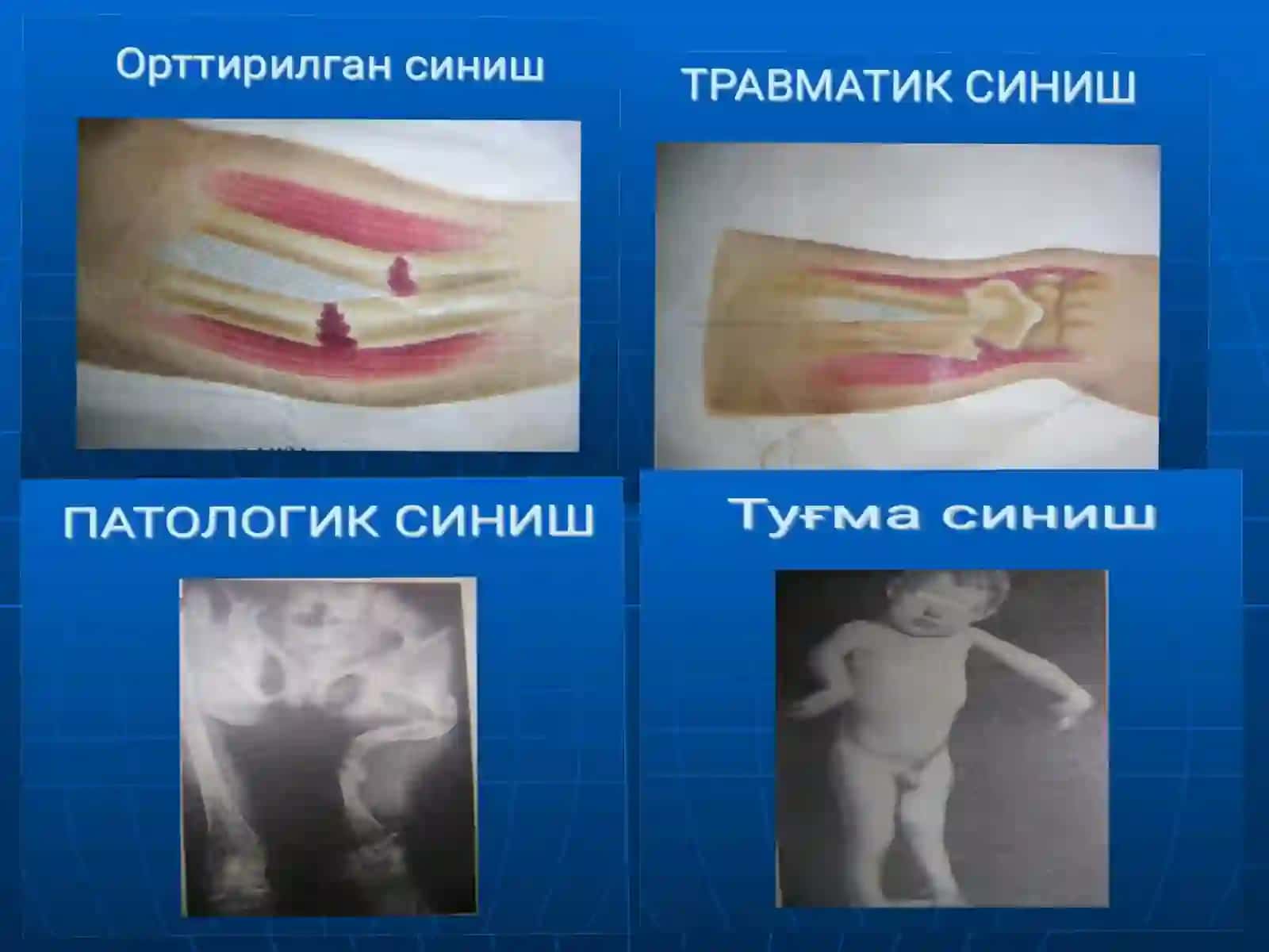 Tayanch Harakat Apparati Sinishlari 3