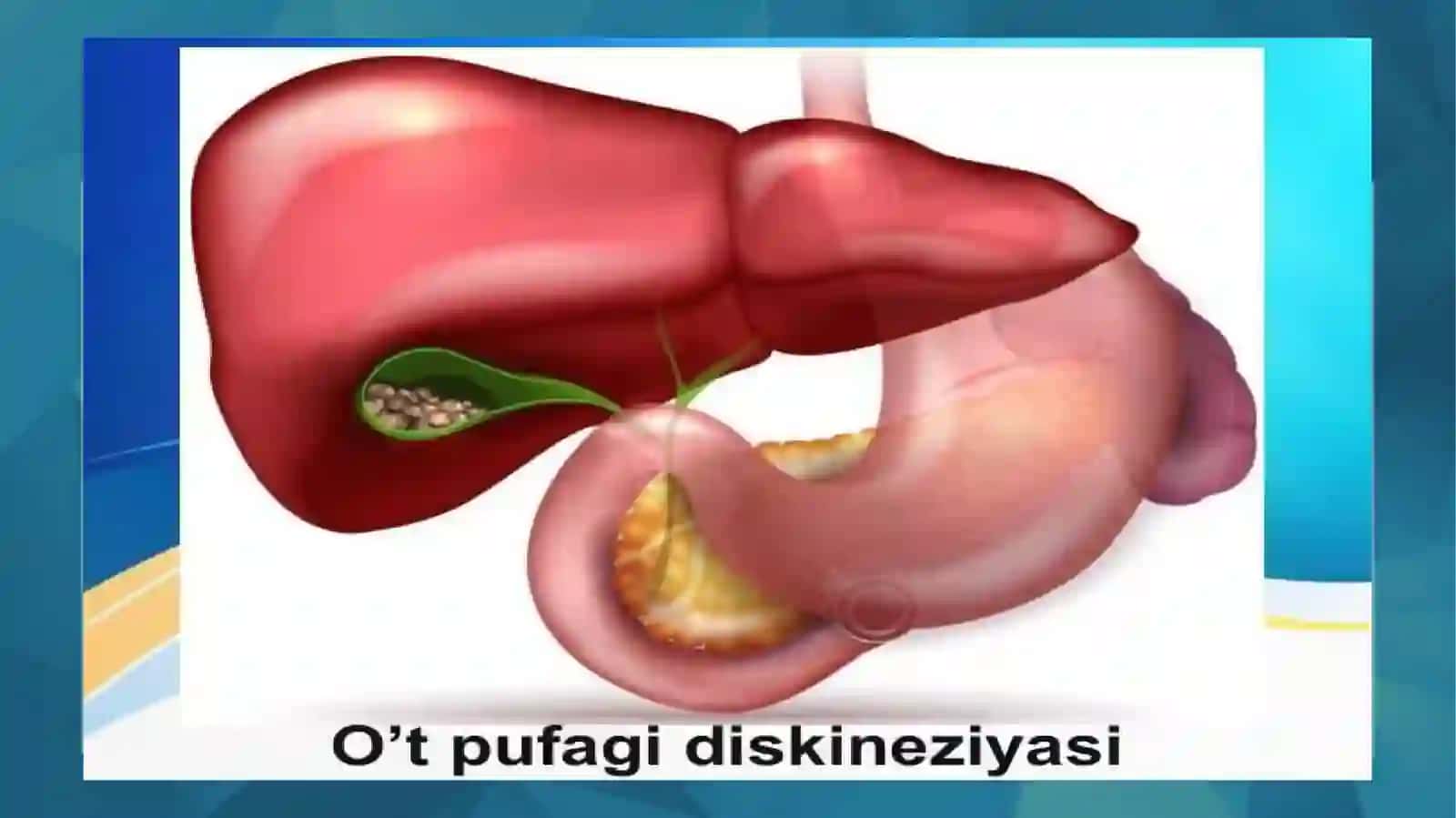 OʻT YOʻLLARI DISKINEZIYASI 3