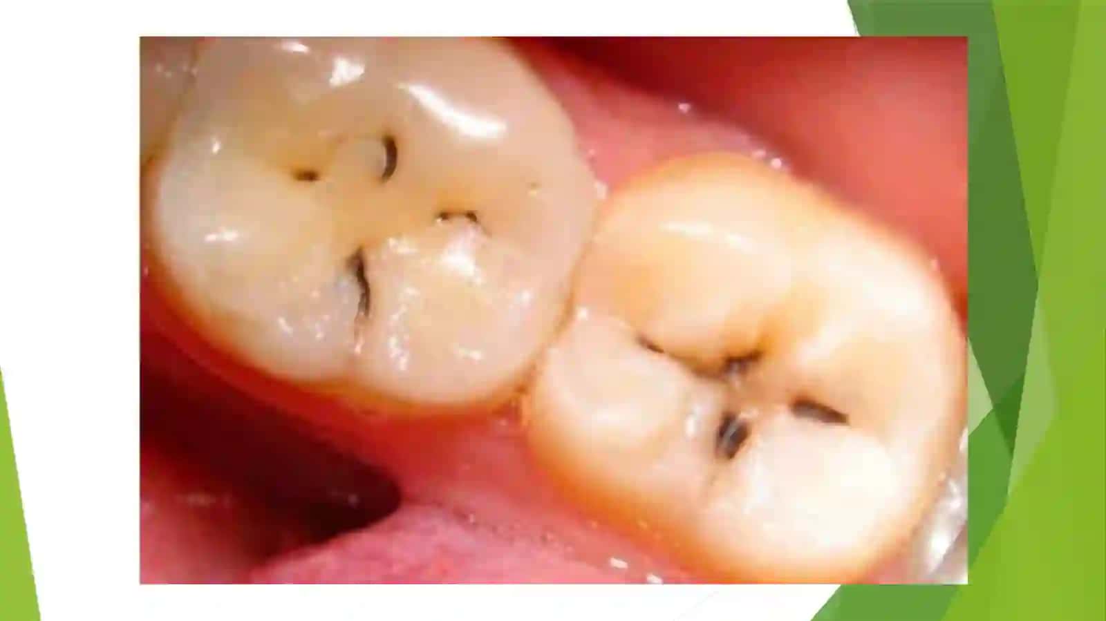 [Yuza karies (Caries superfisialis)] 3