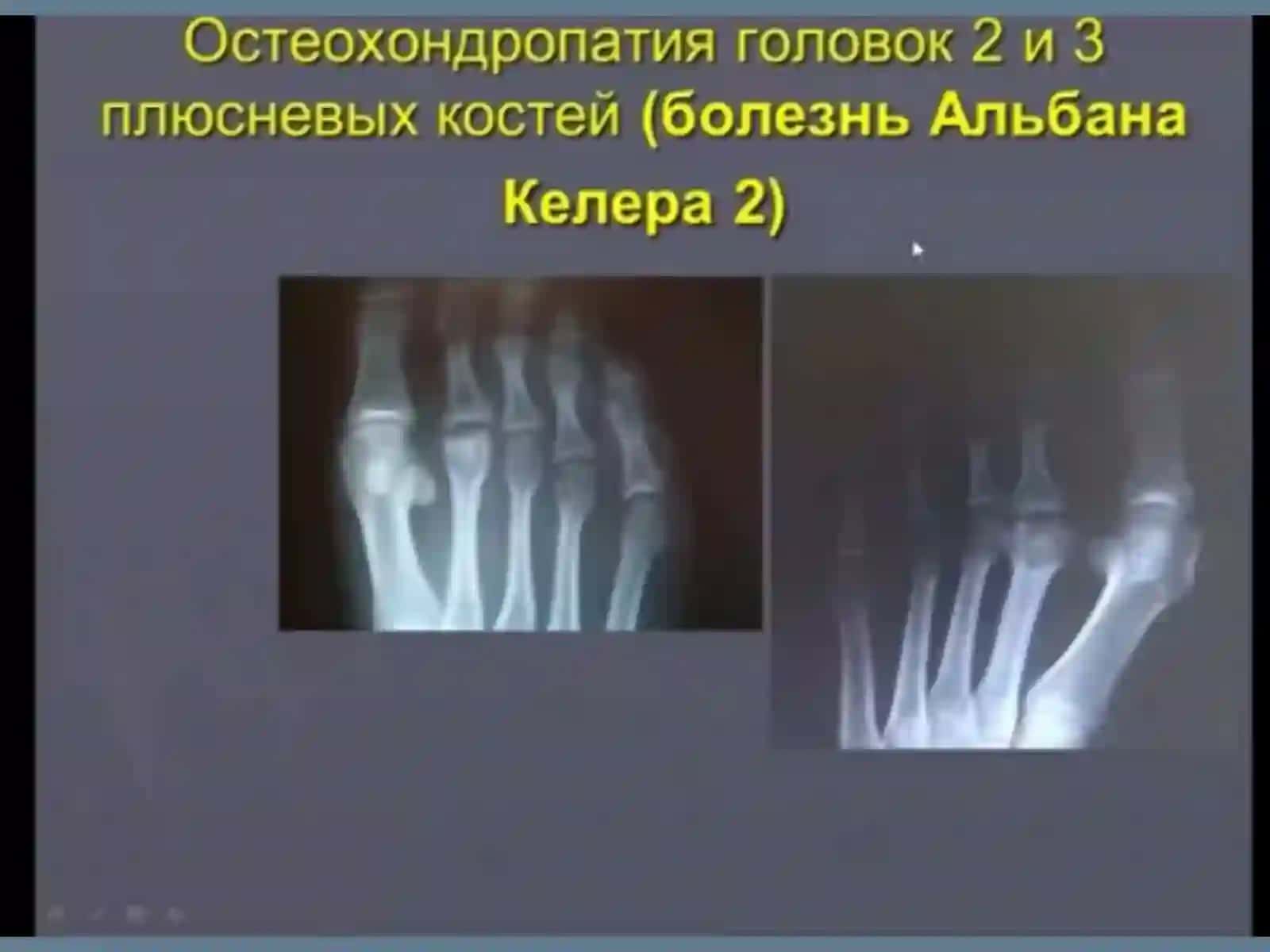 OSTEOXONDROPATIYA 3
