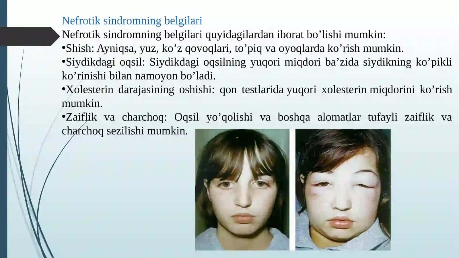 Nefrotik sindrom 3