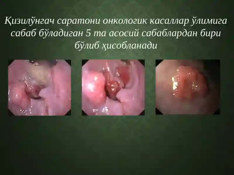 Қизилўнгач саратони 3