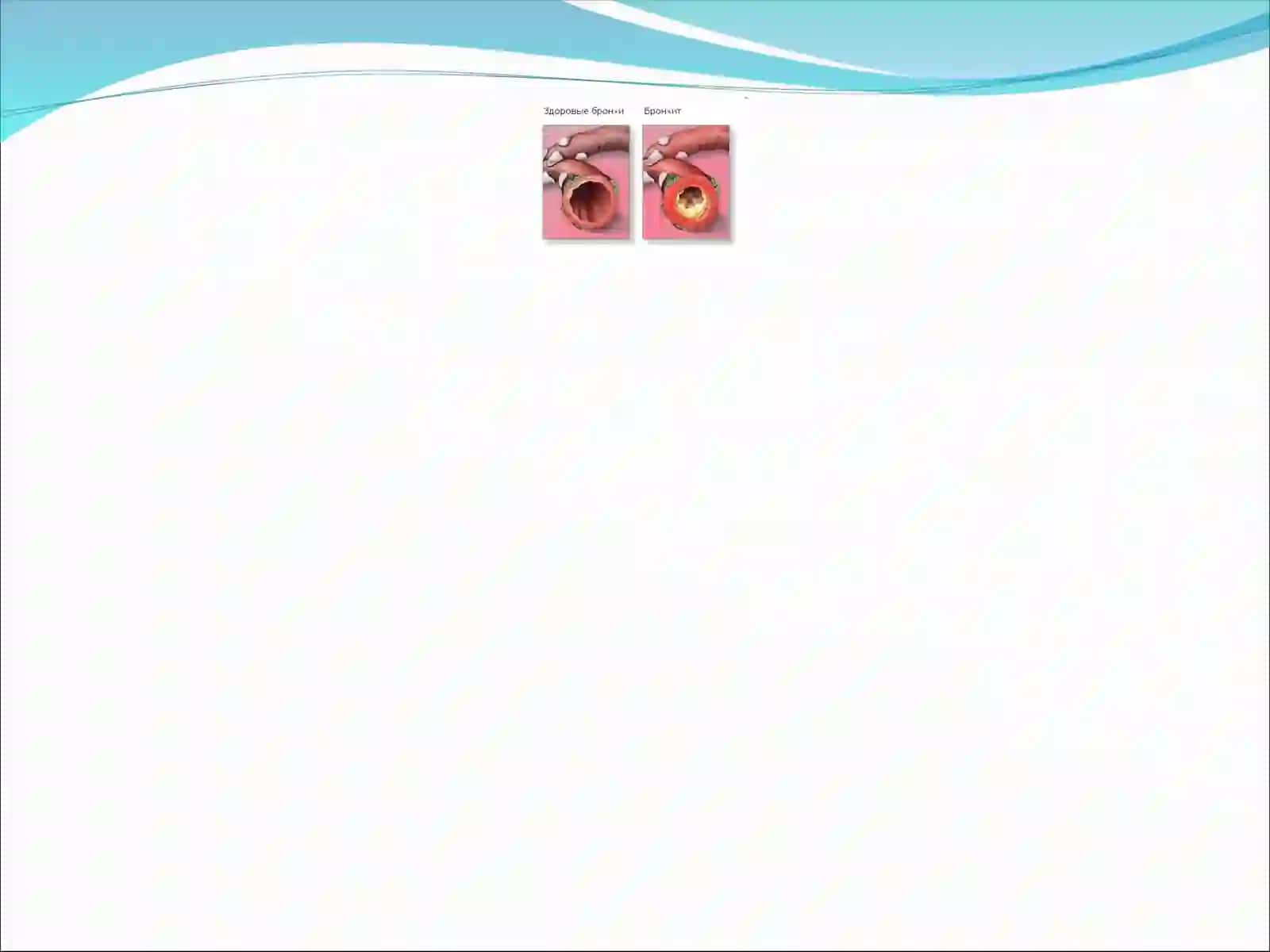 Уткир бронхит (оддий) 3