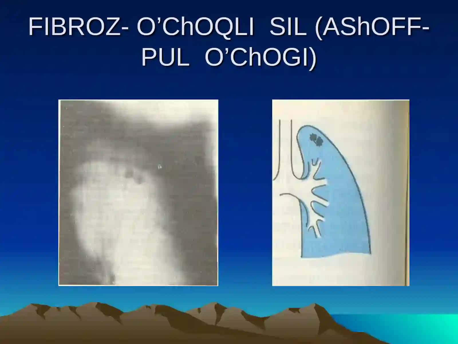 O'choqli sil 3