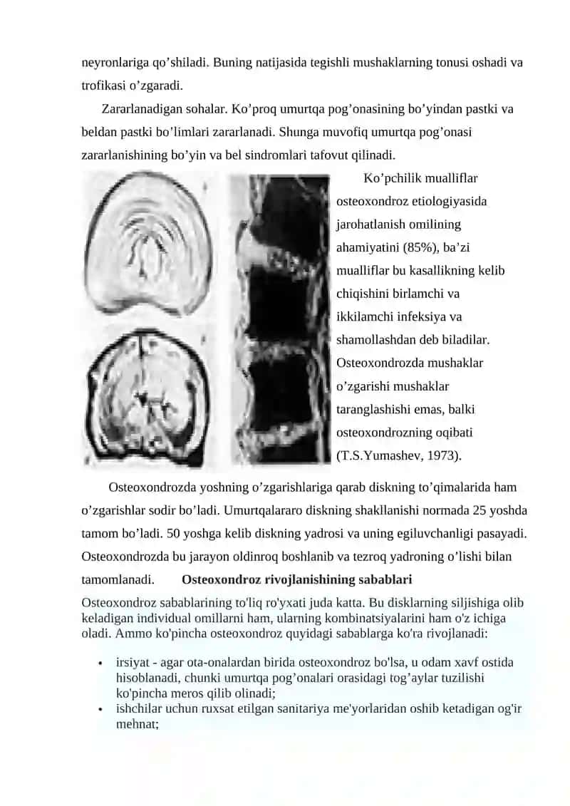 Umurtqa osteoxondrozi 3