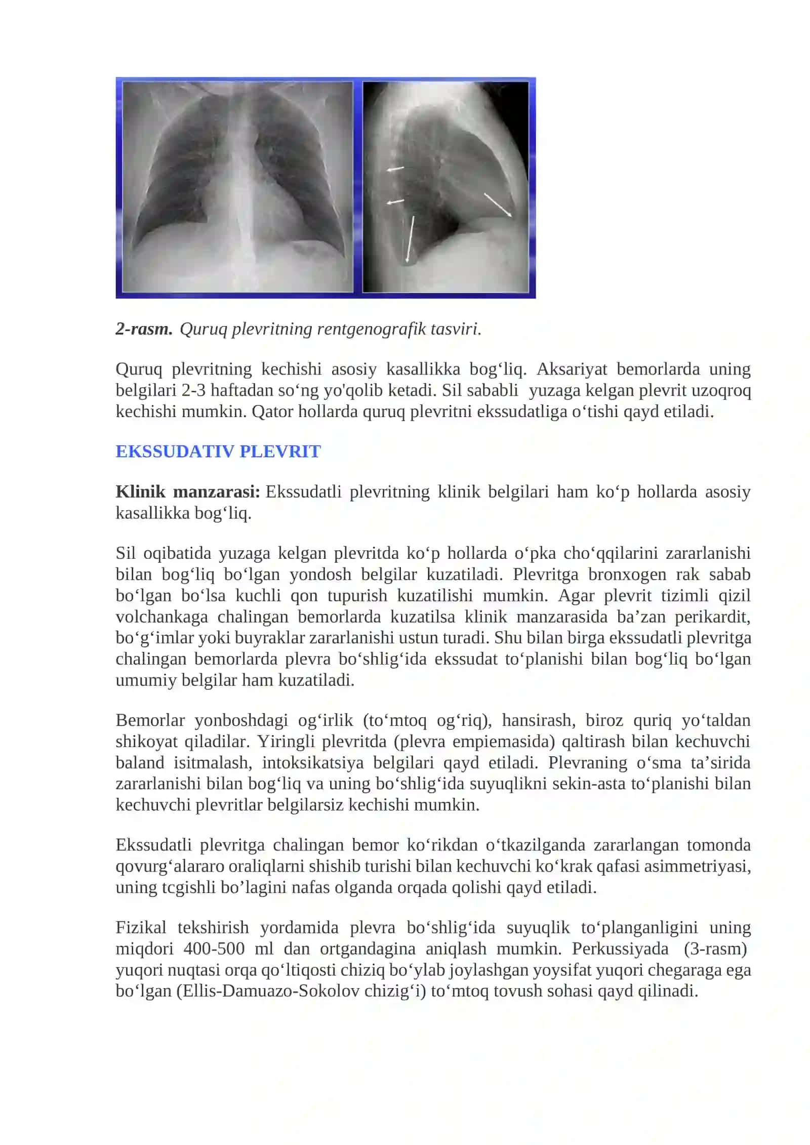 Plevritlar 3