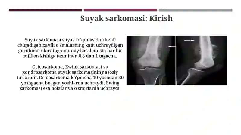 Suyak sarkomasi 3