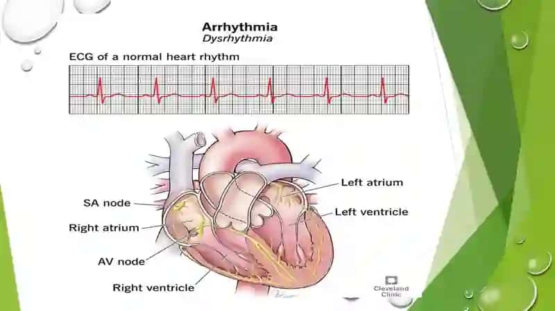 Aritmiyalarda EKG interpretatsiyasi 3