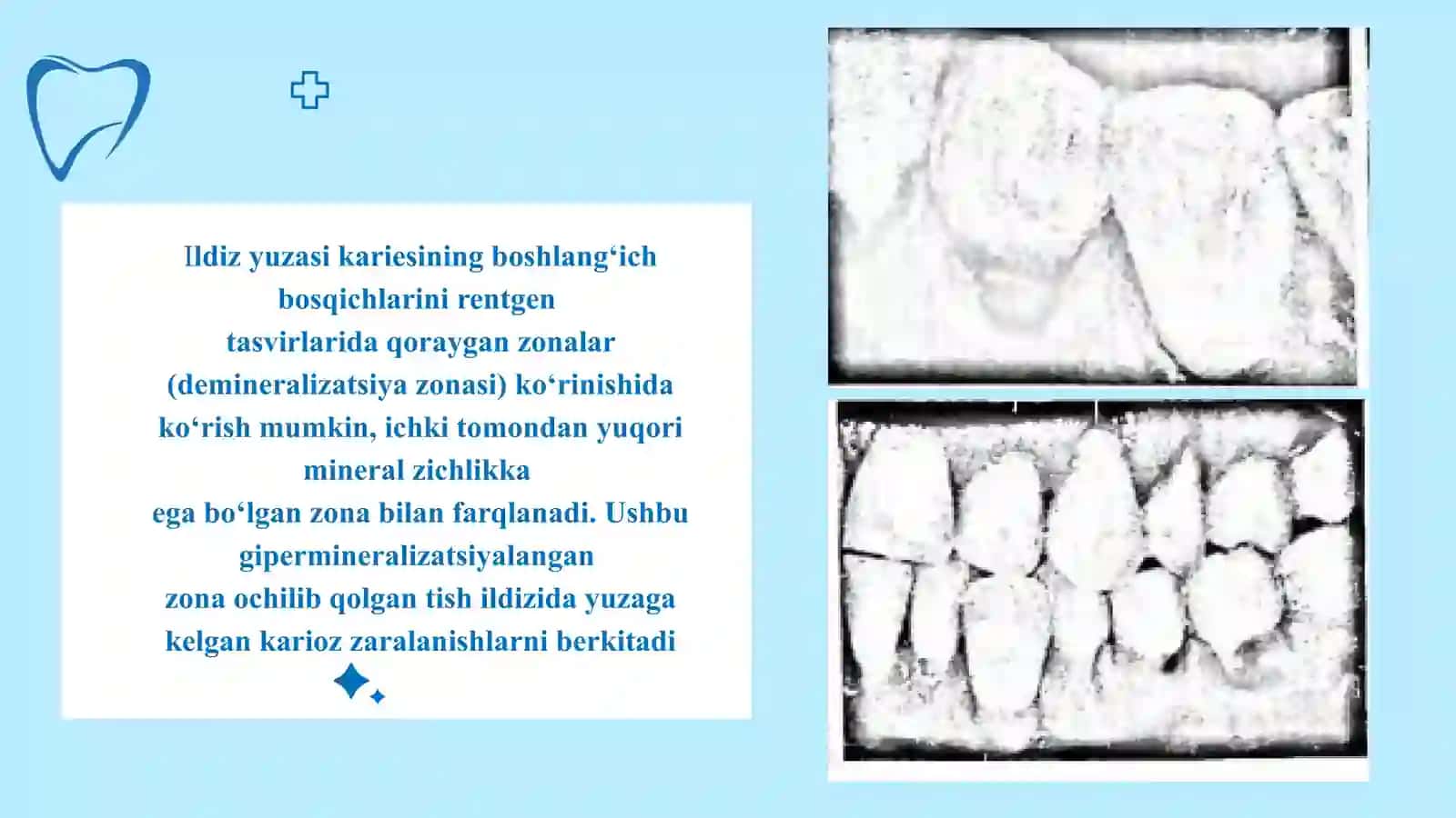 ILDIZ KARIYESI, KLINIKASI, TASHXISLASH, DAVOLASH 3