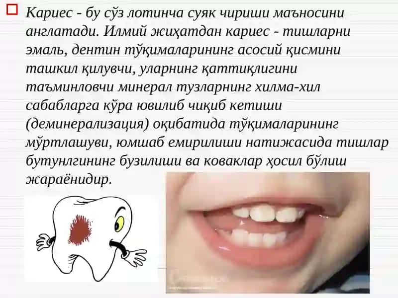 Болаларда тишлар кариеси 3