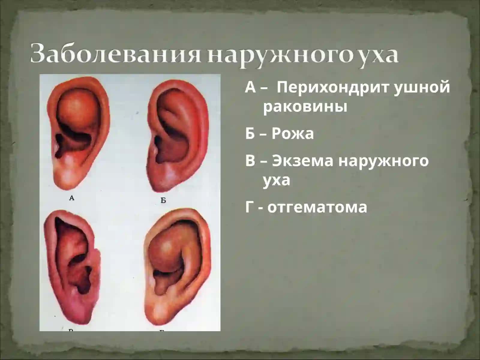 Изучить этиопатогенез заболеваний уха 3