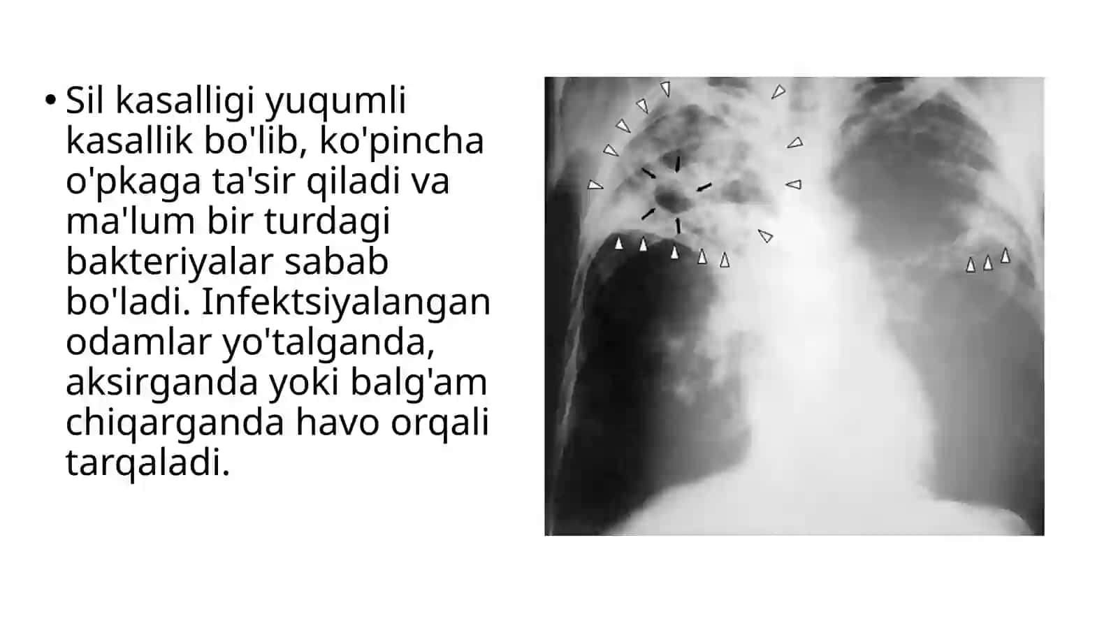 Sil (Tuberkulyoz) 3