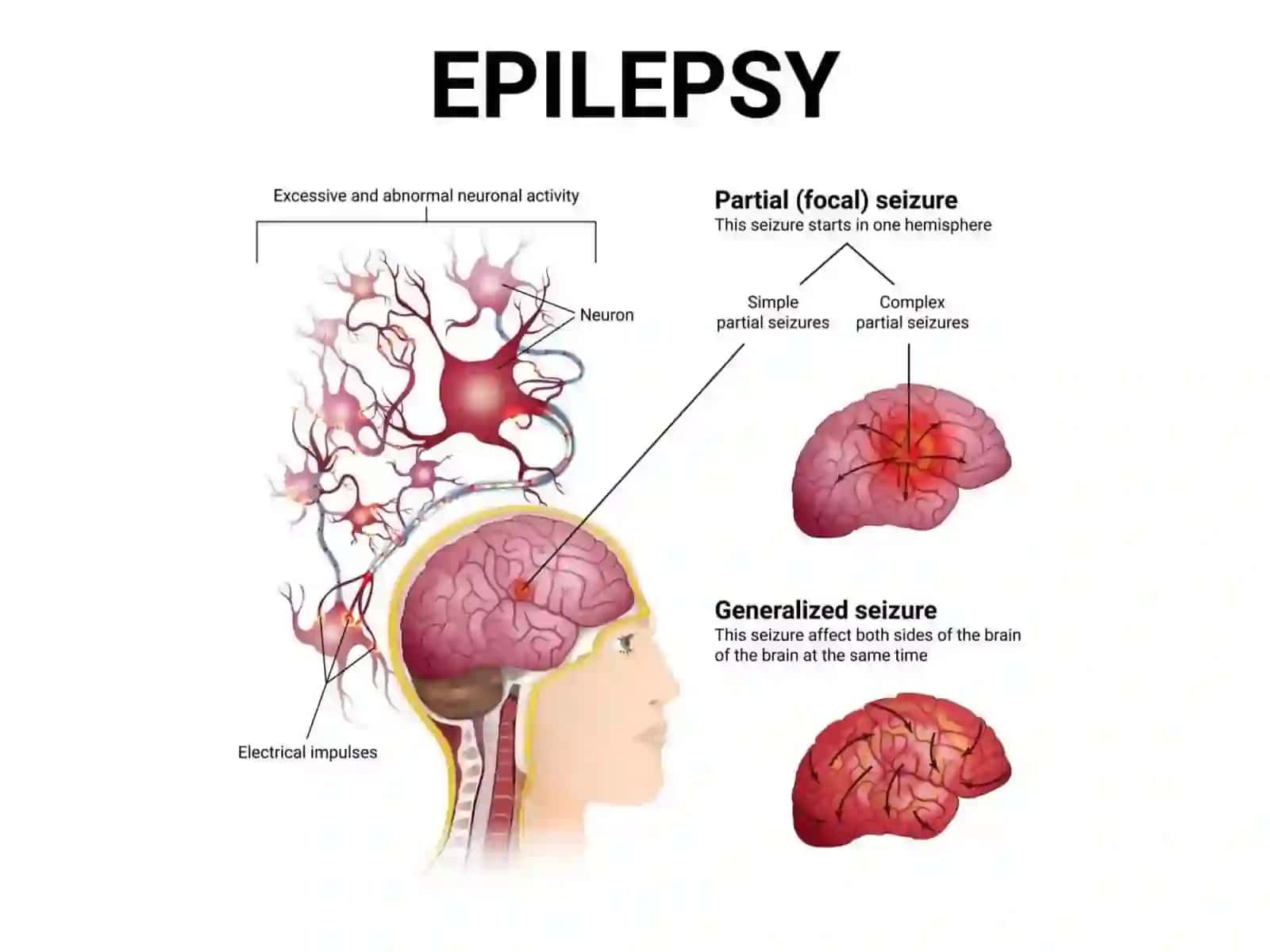 Epilepsiya 3