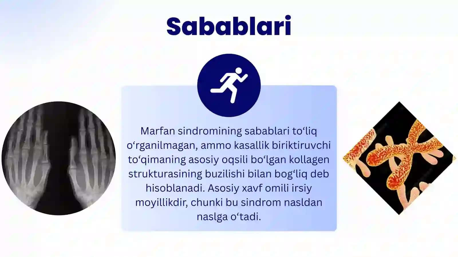 Marfan sindromi 3