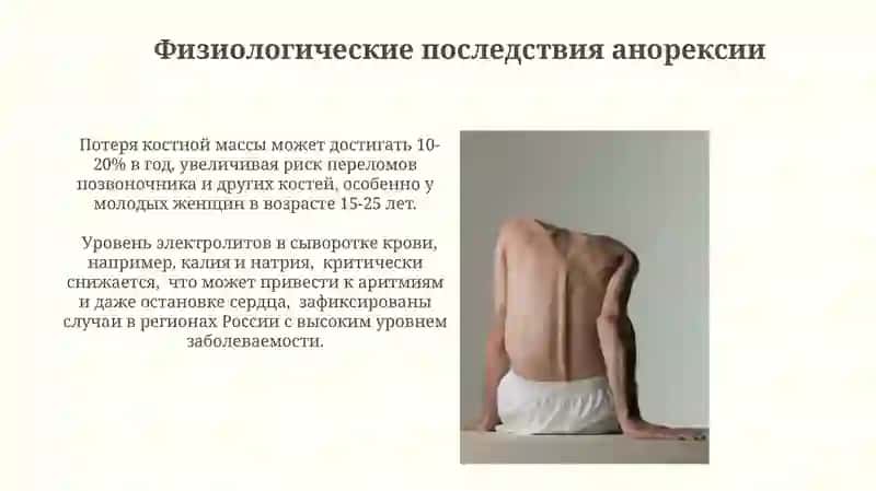 Анорексия 3