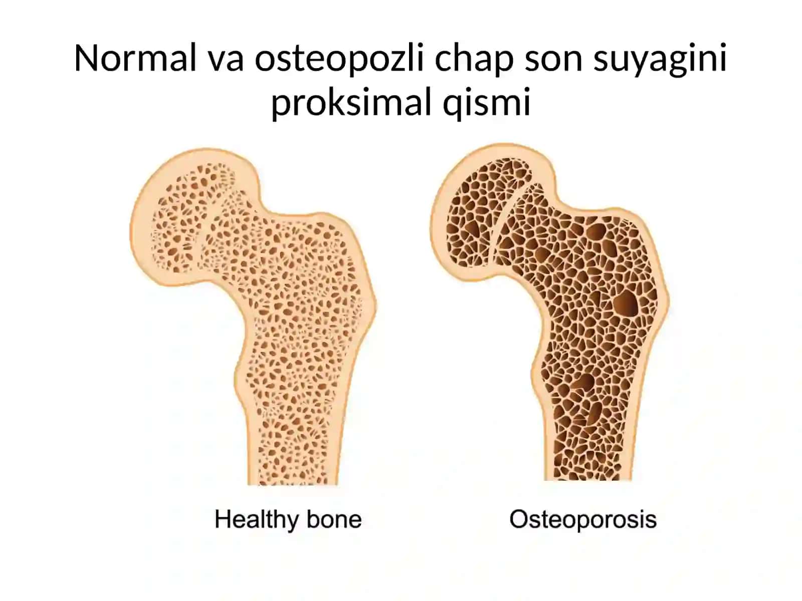 Osteoporoz 3
