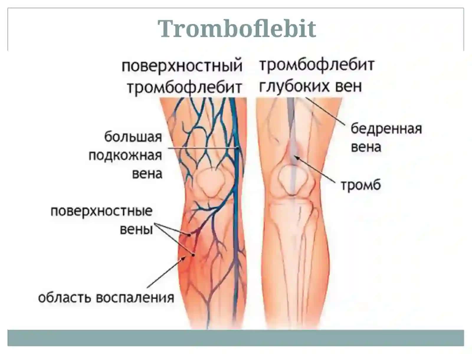 Tromboflebitva flebotromboz 3