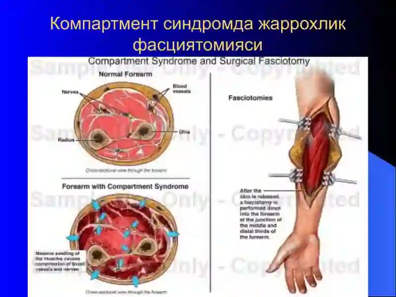 Компармент синдром 3