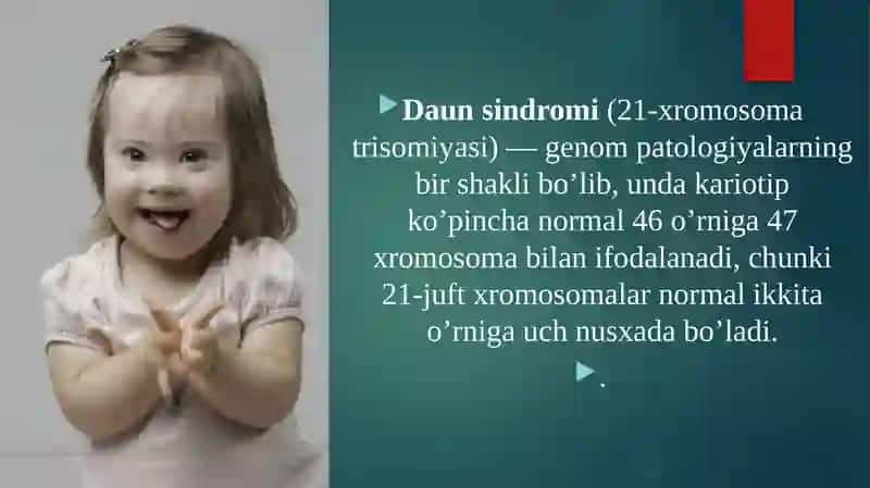 Daun sindromi 3