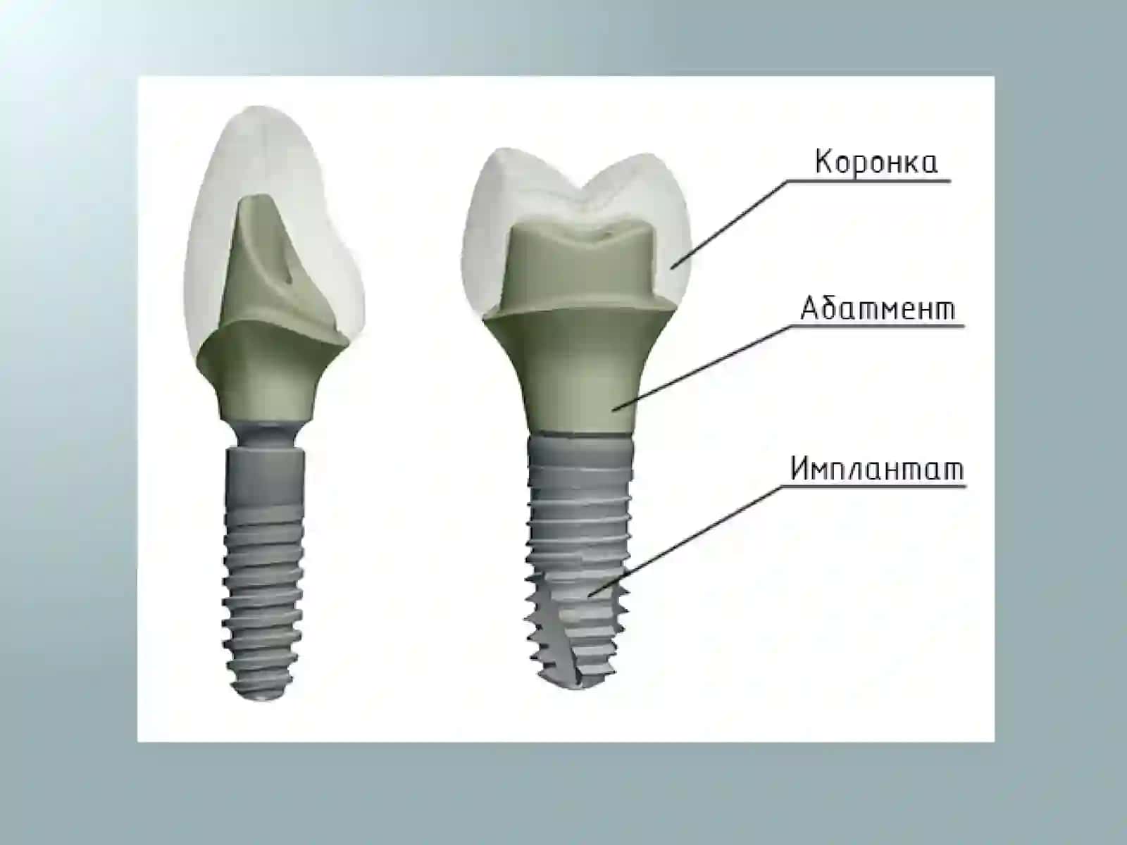 Implantlar asosidagi protezlar 3