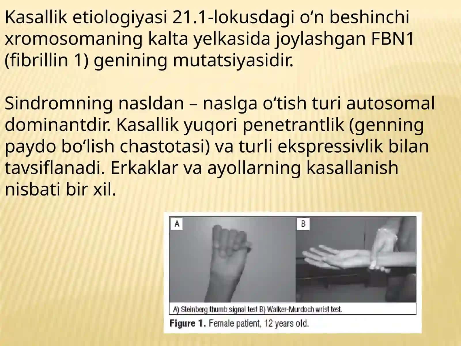 Marfan sindromi 3