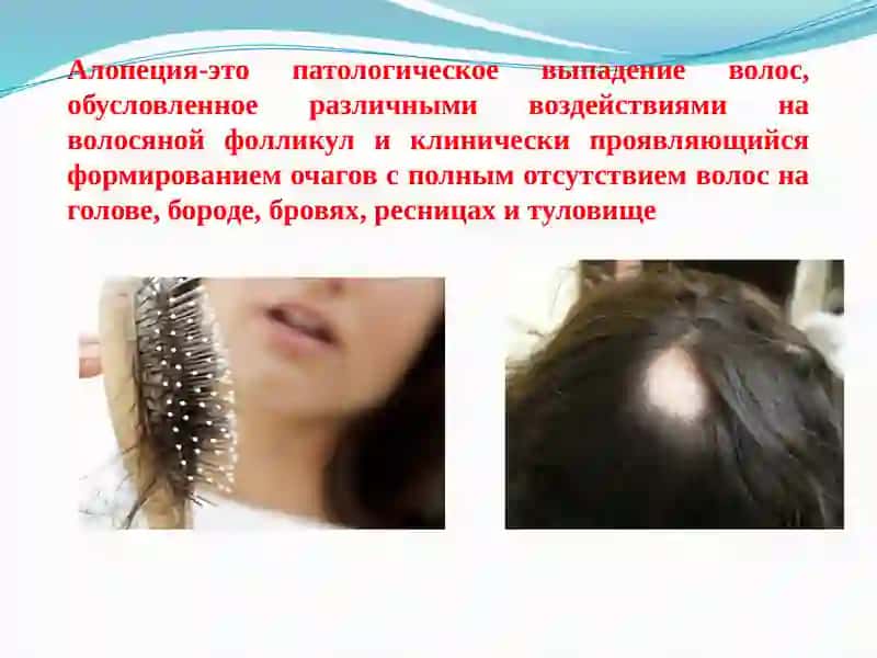 Алопеция 3