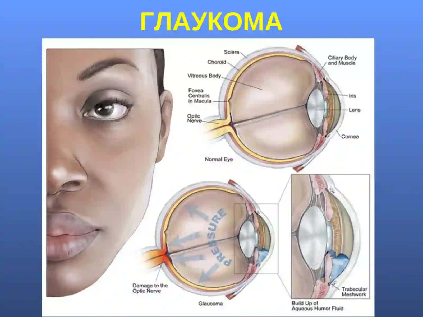 ГЛАУКОМА 3