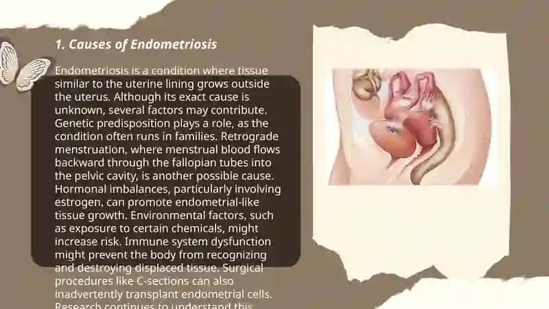 Endometriosis 3