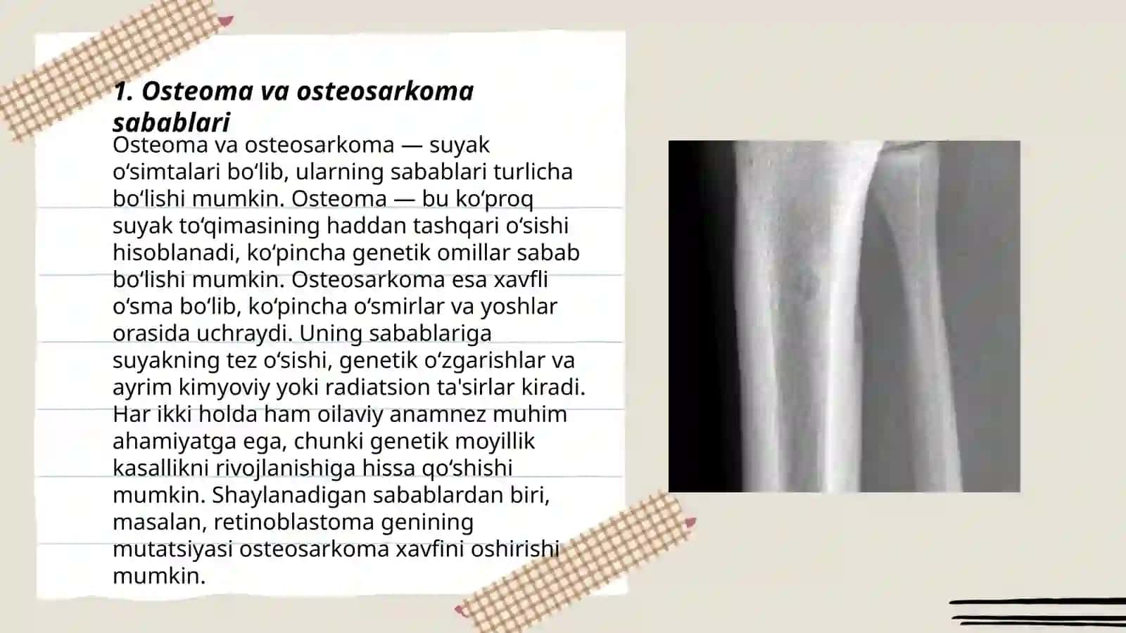 Osteoma Ostesarkoma 3