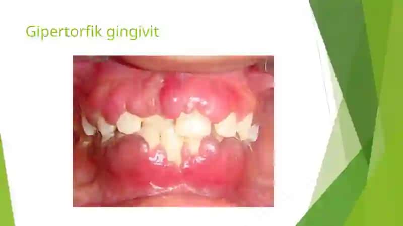 Gipertrofik gingivit 3