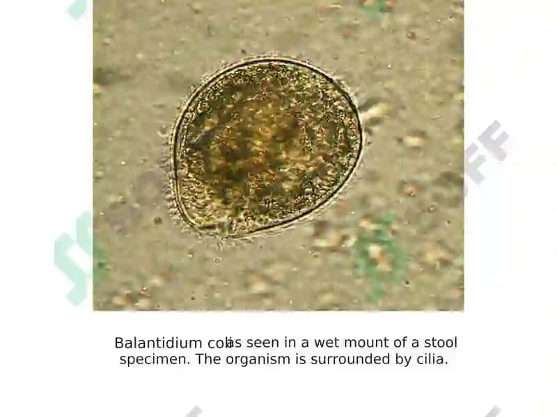 Balantidioz 3